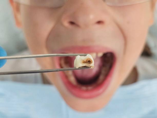 Best Same-Day Emergency Dental Services in Arcanum, OH